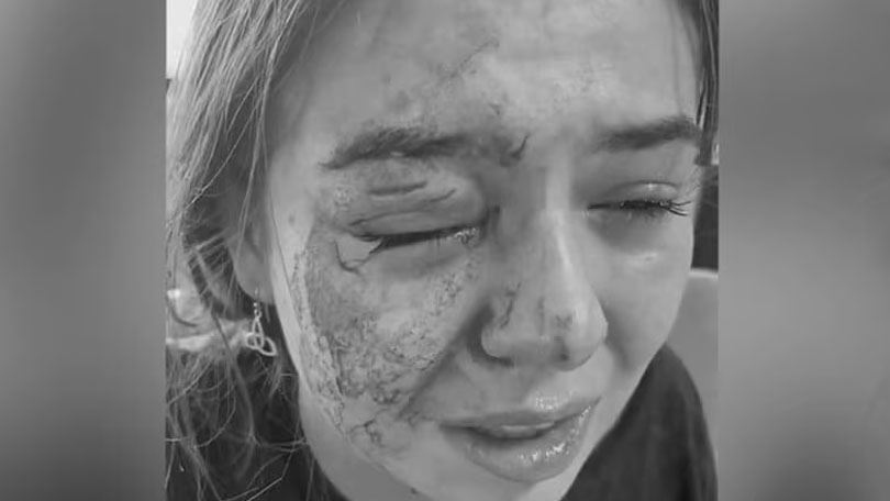 Dcera Eddieho Guerrera utrpěla po brutálním útoku psa ošklivé zranění