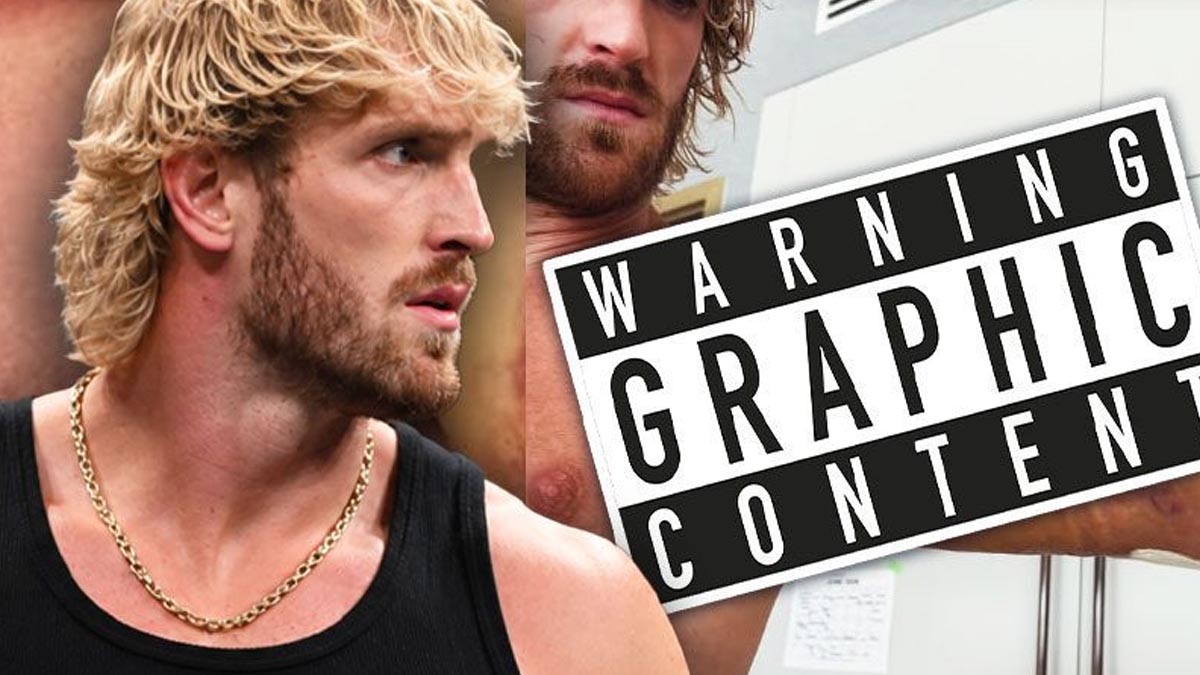 Logan Paul ukázal ošklivé následky zranění tricepsu